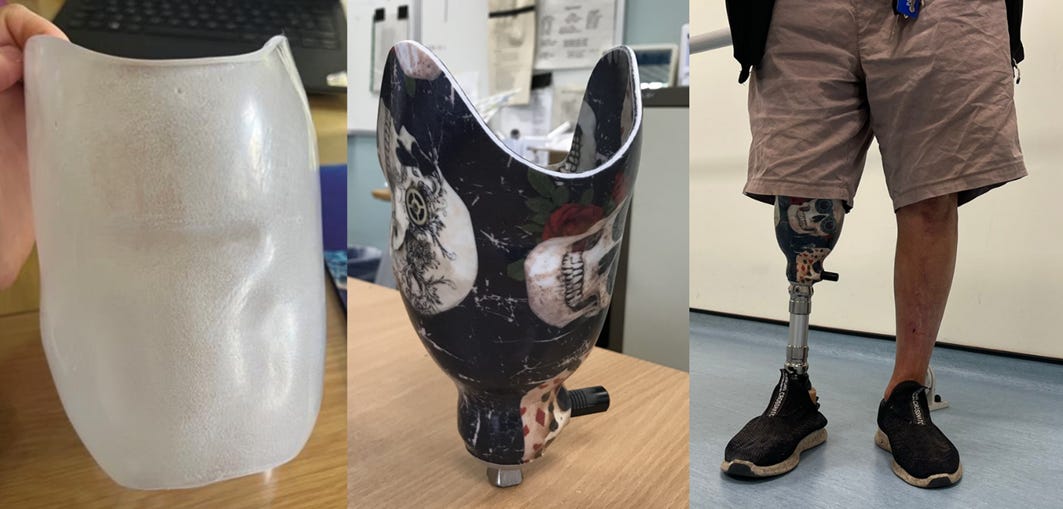 Fitted custom sockets from clinical study